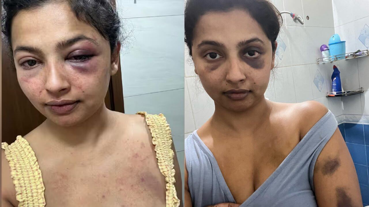 Malayalam actress Anika Vikraman alleges abuse by ex-boyfriend, shares shocking pictures of injury 5004